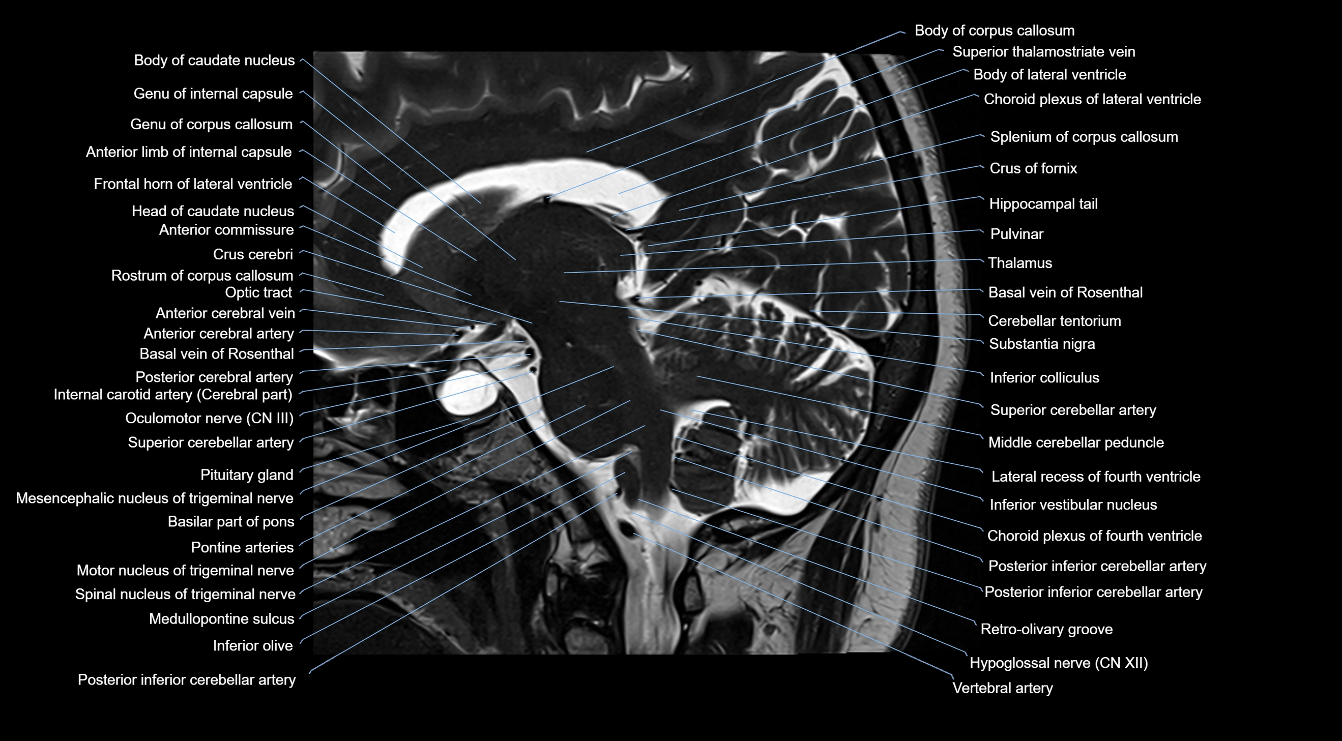 MRI brainstem & basal ganglia anatomy labelled  3T MRI images -img-10001-00020.webp